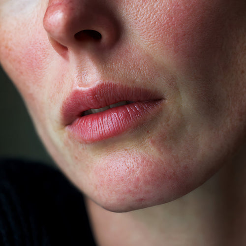 Close-up of a person's face with visible skin conditions