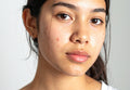 Clear Skin Method | Advanced Acne Healing Certification