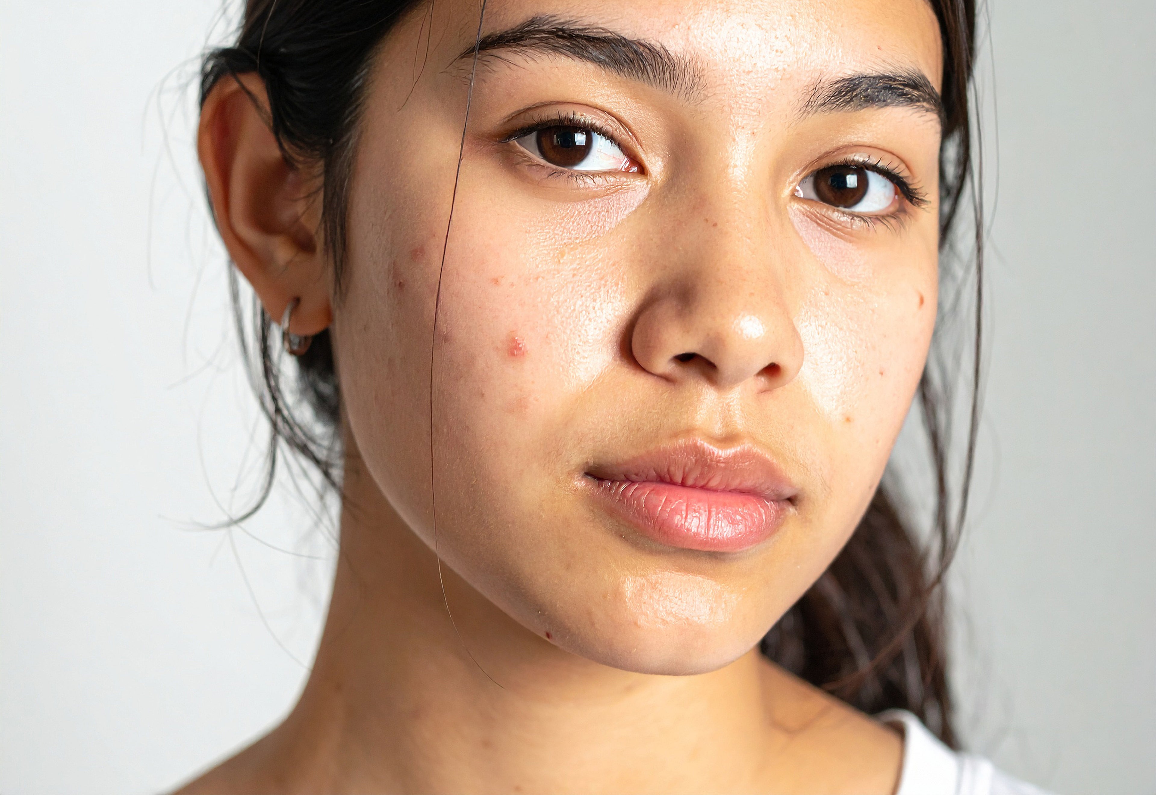 Clear Skin Method | Advanced Acne Healing Certification